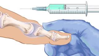 First Metatarsophalangeal Joint Injection [upl. by Pagas]