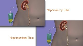 Your Nephrostomy or Nephroureteral Drain [upl. by Orutra]