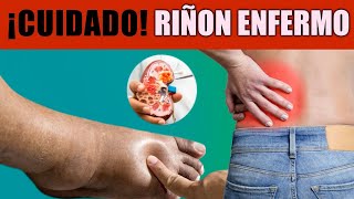 😮Síntomas de PROBLEMAS RENALES para PREVENIR Daños GRAVES [upl. by Nielsen]