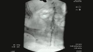 Fluoroscopic Caudal Epidural Contrast Spread [upl. by Dowzall]