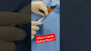 What Is Caudal Epidural Block Dr Sai Chandra [upl. by Nylra]