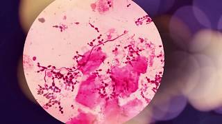 Candida albicans introduction morphology pathogenesis lab diagnosis and treatment [upl. by Diet]