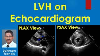 LVH on Echocardiogram [upl. by Maison]