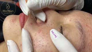 Loan Nguyen Acne Treatment 0794hn [upl. by Miculek]