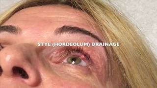 Draining a Stye Hordeolum on the left eye [upl. by Eseneg278]