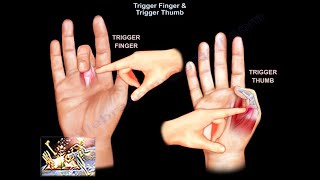 Trigger Finger amp Trigger Thumb  Everything You Need To Know  Dr Nabil Ebraheim [upl. by Audwen]