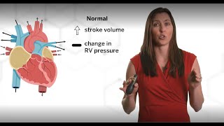 Right Ventricular Dysfunction and Pulmonary Hypertension [upl. by Akihsan]