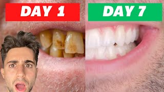 I Tried Crest Whitening Strips For 7 Days INSANE RESULTS Honest Review [upl. by Edson139]