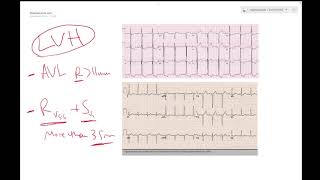 LVH on ECG Left ventricular hypertrophy  Learn ECG  Dr Jamal USMLE [upl. by Nothsa]