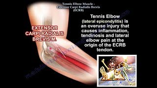 Tennis Elbow Extensor Carpi Radialis Brevis Everything You Need To Know  Dr Nabil Ebraheim [upl. by Abigail]