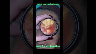 Retinochoroidal coloboma shorts opthalmology neetpg [upl. by Neersan]