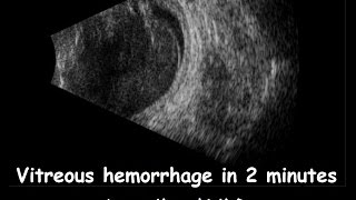 Vitreous hemorrhage in 2 minutes [upl. by Aralomo]