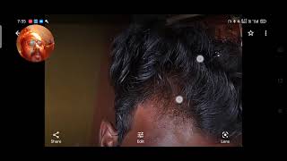 Hair Miniaturization in Tamil  How to Turn Baby Hair To Thick Terminal Hair [upl. by Lienaj]