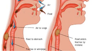 Aspiration Pneumonia [upl. by Kizzee]