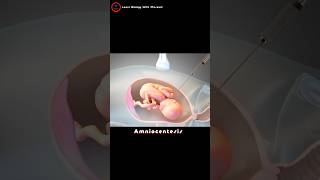 What is an amniocentesis  Amniotic fluid check up [upl. by Merwin]