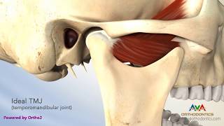 TMJ Disorder or TMD  Clicking and Closed Lock [upl. by Ociram]