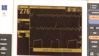 Waveform capnography demonstration [upl. by Rubenstein]