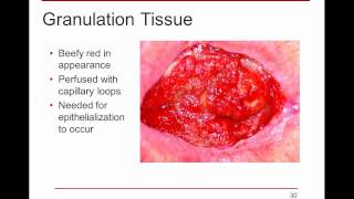 WoundRounds Free Webinar  PUSH Tool for Monitoring Pressure Ulcer Healing A Practical Guide [upl. by Monahon587]