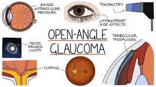 Understanding Open Angle Glaucoma [upl. by Enelkcaj]