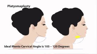 Part 1313 Platysmaplasty Neck Tightening Surgery  Dr Thomas Buonassisi 8 West Clinic in BC [upl. by Ahsaten]