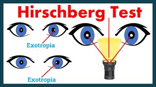 Hirschberg Corneal Reflex Test  A complete Tutorial [upl. by Leilah]