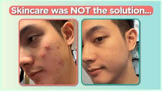 Confused sa pag treat ng ACNE Start here Beginners Guide  Jan Angelo [upl. by Kessiah]