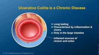 What is Ulcerative Colitis [upl. by Forsyth]