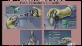 PMA  Procreazione medicalmente assistita [upl. by Nea]