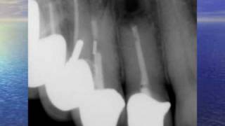 Fistula Could Trick You  Three Endodontic Cases [upl. by Idnam]