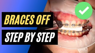 BRACES OFF  Step by step orthodontic removal [upl. by Cirdet584]