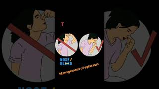 Management of epistaxis nosebleed epistaxis orthopedics mbbs [upl. by Cargian214]