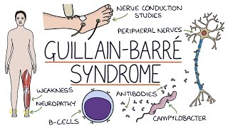 Understanding GuillainBarré Syndrome [upl. by Darryn855]