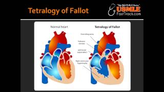 Tetralogy of Fallot [upl. by Drawoh]