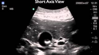 How To Gallbladder Ultrasound Part 2  Gallstones Case Study Video [upl. by Aliekat]