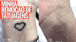 TUDO SOBRE MINHA REMOÇÃO DE TATUAGEM [upl. by Dunston430]