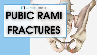 Pubic Rami Fractures  What are they How do you treat them [upl. by Dermot902]