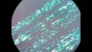 Negative birefringence of urate crystals in gout [upl. by Ecenaj431]