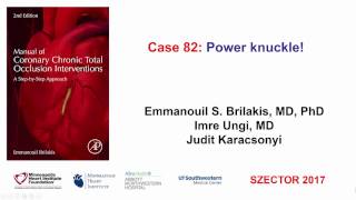 Case 82 Manual of CTO Interventions BASE balloonassisted subintimal entry [upl. by Simon]