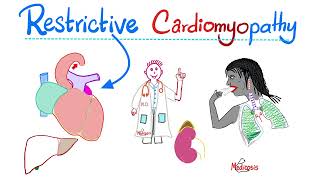 Restrictive Cardiomyopathy  Causes Symptoms Diagnosis amp Treatment  Cardiology Series [upl. by Mcintosh389]