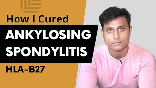 How I Cured My Ankylosing Spondylitis  Ayurvedic Treatment [upl. by Landre931]