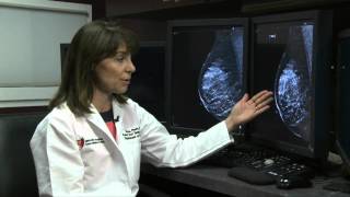 2D vs 3D Mammography [upl. by Piselli498]