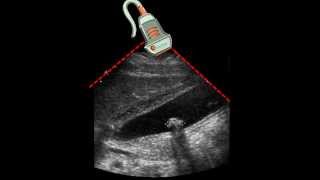 Ultrasound of Gallbladder amp Gallstone [upl. by Shoemaker]