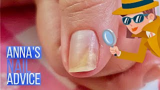 Nail Separation  Causes  Early Treatment of Onycholysis Annas Nail Advice [upl. by Harcourt276]