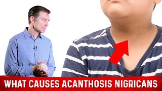 What Causes Acanthosis Nigricans Darkened Skin Folds – Dr Berg [upl. by Calbert]