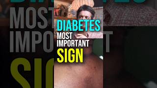 Dark Patches on Skin Discover the Hidden Sign of Diabetes – Acanthosis Nigricans shorts ytshorts [upl. by Octavie]