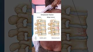 Spinal deformity kyphosis patient shortvideo medicalknowledgeonline [upl. by Eilojne]