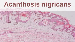 Acanthosis Nigricans  Pathology mini tutorial [upl. by Santos]