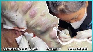 Big Cystic Acne Blackheads Extraction Blackheads amp Milia Whiteheads Removal Pimple Popping [upl. by Flossy]