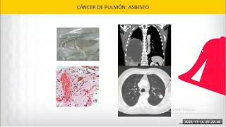 CLASE TEORICA CANCER DE PULMON 2023II [upl. by Munn982]