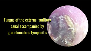 Fungus of the external auditory canal accompanied by granulomatous tympanitis [upl. by Nannarb]